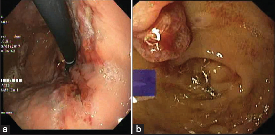 Upper GI endoscopy on readmission showing (a) healed ulceration in fundus and (b) multiple polypoidal lesions in duodenum (D1)