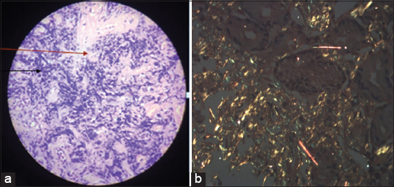 (a) Histopathology of body of stomach showing moderate chronic lymphoplasmacytic infiltrate (black arrow) with lamina propria showing glassy pink material separating glands (red arrow) suggestive of amyloidosis. (b) Staining with Congo red showed characteristic apple green birefringence under polarized light (×10)