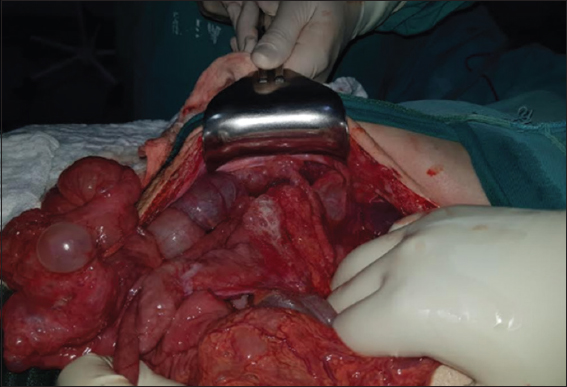Cystic lesions in the small intestine, mainly in the jejunum with a stenotic area 110 cm from the Treitz ligament, another cystic zone 160 cm from the same ligament without light compromise, cystic lesions in the transverse colon subserosa without light compromise and greater omentum with multiple cystic lesions without any repercussion