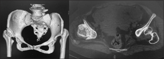 Computed tomography scan demonstrating a high dislocation dysplasia and right false acetabular sclerosis