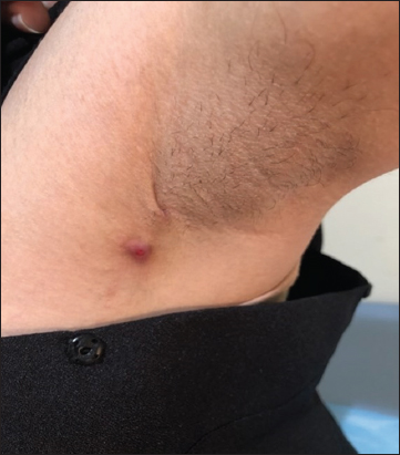 The affected area following surgery