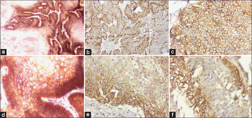 Representative figures of IHC staining for CD133 and CD44 in the OSMF and OSCC groups. Microscopic illustration of CD133 expression in normal oral epithelial tissue after IHC staining; 200× magnification (a) OSCC tumor tissue stained for CD133 expression demonstrates cytoplasmic staining at a 200× magnification. (b) CD133 immunostaining confirms that OSMF-displaying inflammatory cells are dispersed among the oral epithelium’s layers, magnification 200× (c) Normal buccal mucosa showing CD44 expression in the majority of epithelial cells, including fibroblasts, magnification 200× (d) Membranous IHC sections from well-differentiated OSCC exhibit positive CD44 expression, magnification 200× (e) IHC labeling of CD44 reveals the OSMF stage and active cells in the oral submucosa’s juxtaepithelial connective tissue, magnification 200× (f)