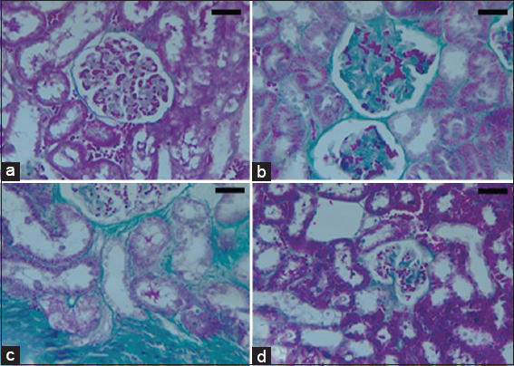 (a-d) Microscopic appearance from kidney tissues of the experimental rats (Photomicrograph of 5 microns thickness, Mason’s Trichrome stained paraffin section, ×400). Normal kidney with normal cortical glomeruli and tubules (a). Dinitrophenol (DNP) hypoxic group shows glomerulus with diffuse glomerulosclerosis, increased mesangial matrix (b) and thickening of capillary wall with periglomerular interstitial fibrosis (c). DNP + Nigella sativa treated group demonstrates decreased glomerular size, mesangial matrix and glomerular basement membrane (d). Scale bars 100 μm in (a-d)