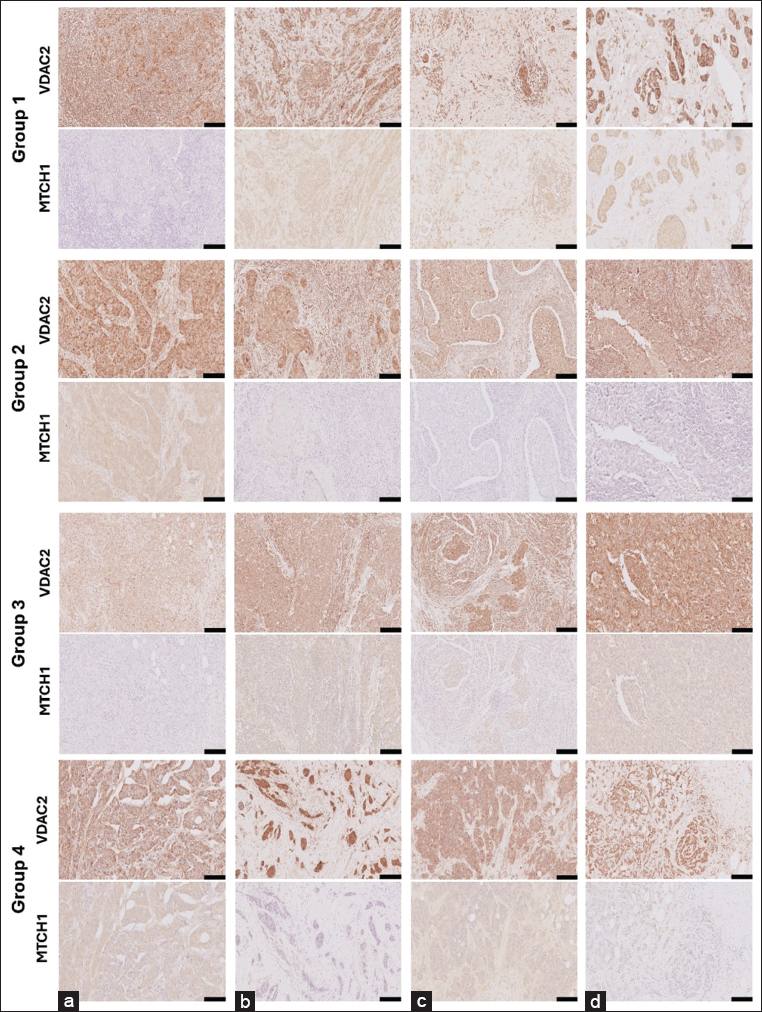 Group1- VDAC2 (a) MTCH1 (a): A 51-year-old female diagnosed with invasive ductal carcinoma (IDC). The tumor measured 30 mm with a Nottingham grade of 2, marked TILs at 90%, and was classified as Stage IIIA (pT2 pN2 M0). Adjuvant chemotherapy included AC and Taxotere. Group1- VDAC2 (b) MTCH1 (b): A 61-year-old female presenting IDC with associated DCIS. The tumor size was 30 mm, graded 2, with mild TILs under 10%. Staged as IIA (pT2 pN0sn), with no lymph node involvement. Group1- VDAC2 (c) MTCH1 (c): A 43-year-old female with IDC exhibiting a 50 mm tumor and a Nottingham grade of 2. Tumor necrosis present before NAC. TILs were mild at 15%, staged as IIB (pT2 pN0). The patient received neoadjuvant AC chemotherapy. Group1- VDAC2 (d) MTCH1 (d): A 75-year-old female diagnosed with IDC and DCIS. The tumor measured 35 mm, was graded 2, and had mild TILs under 10%. Stage IIIA (pT2 pN2a), with positive lymph nodes in 5 7 samples. Group2- VDAC2 (a) MTCH1 (a): A 67-year-old female with metaplastic carcinoma with squamous differentiation, no DCIS present. Tumor size was 70 mm, with a Nottingham grade of 3, marked TILs at 80%, and classified as Stage IV with metastasis at diagnosis. Group2- VDAC2 (b) MTCH1 (b): A 36-year-old female presenting IDC with extensive DCIS. The tumor measured 10 mm, graded 3, with marked TILs at 90%. Staged as IIIA (pT1b pN2a), with positive lymph nodes in 7 of 18 samples. Group2- VDAC2 (c) MTCH1 (c): A 49-year-old female diagnosed with IDC, no DCIS. The tumor was 35 mm in size, graded 3, with marked TILs at 80%. Stage IIIA (pT2 pN2a), with lymph node involvement (7/15). Group2- VDAC2 (d) MTCH1 (d): A 37-year-old female with IDC, measuring 40 mm, grade 3, marked TILs at 80%. Staged IIA (pT2 pN0(sn)), receiving FAC chemotherapy post-diagnosis. Group3- VDAC2 (a) MTCH1 (a) :A 34-year-old female diagnosed with IDC with atypical medullary features, no DCIS. The tumor measured 20 mm, graded 3, with moderate TILs at 50%. Staged IA (pT1c pN0). Group3- VDAC2 (b) MTCH1 (b) :A 58-year-old female presenting IDC, no DCIS, tumor size 30 mm, graded 3. Moderate TILs at 50%, staged as IIA (pT2). Group3- VDAC2 (c) MTCH1 (c) :A 49-year-old female with IDC and focal micropapillary features, no DCIS. Tumor size was 25 mm, graded 3, with moderate TILs at 65%. Staged as IIB (pT2 pN1a). Group3- VDAC2 (d) MTCH1 (d): A 42-year-old female diagnosed with IDC, no DCIS. The tumor was 25 mm in size, graded 3, with moderate TILs at 55%. Staged as IIA (pT2 pN0). Group4- VDAC2 (a) MTCH1 (a): A 50-year-old female presenting IDC with DCIS. Tumor size was 95 mm, graded 3, with mild TILs at 10%. Staged as IC (pT3 pN3), showing metastatic progression. Group4- VDAC2 (b) MTCH1 (b): A 42-year-old female diagnosed with IDC, DCIS, present. Tumor size 12 mm, grade 3, with mild TILs under 10%. Staged as IIA (ypT1c ypN1a) post-NAC. Group4- VDAC2 (c) MTCH1 (c): A 57-year-old female with IDC and associated DCIS. Tumor size was 88 mm, graded 3, with mild TILs under 10%. Staged as IIIC (pT4b pN3a), with metastatic lung spread noted. The width of the scale bar (▬) at the bottom right corner of each image is equivalent to 100 μM