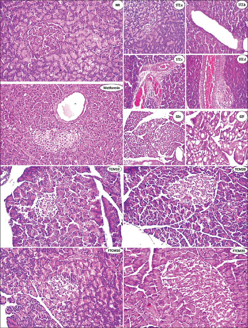 NR group. There was no histopathological alteration, and the typical histological structure of the islets of Langerhans was recorded as an endocrine portion. The acini and ducts system was recorded as an exocrine one. STZ group, a-f. Showing atrophy and regression in size as well as the shape of the islet of Langerhans cells (STZ.a), showing cystic dilatation of the duct (STZ.b), showing severe congestion in stromal blood vessels between the lobules (STZ.c), showing sclerosis in the wall of congested stromal blood vessels (STZ.d), showing fatty change in the lining epithelium of some acini in the lobules (STZ.e), and magnification of this section to identify the fatty change in epithelium cells was shown (STZ.f). In the metformin group, there was no histopathological alteration in the islet of Langerhans cells, while the ducts showed cystic dilatation. In the TCM10 group, there was moderate size and shape in the islet of Langerhans cells as detected. In the TCM20 group, no histopathological alteration was recorded. In the FTCM10 group, the islet of Langerhans cells showed a small size and shape with regression in the distribution all over the lobules. In the FTCM20 group, there was an increase in the size, shape, and distribution of Langerhans cells in the is let all over the lobules. TCM: Turmeric-camel milk, FTCM: Fermented turmeric-camel milk, TSTZ: Streptozotocin, NR: Normal rats